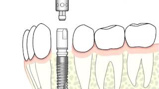 ANKYLOS Surgical and Prosthetic procedure [upl. by Winnifred246]