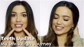 Invisalign Update Journey  More Refinements [upl. by Aicele]