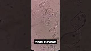 Causes of Epithelial Cells in Urine [upl. by Elenahc]