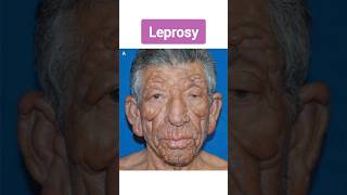 Leprosy  कुष्ट रोग का पूरा इलाज़ संभव है  यह परेशानी आपके हाथों को पूरा ख़राब कर देता है  leprosy [upl. by Ademla]