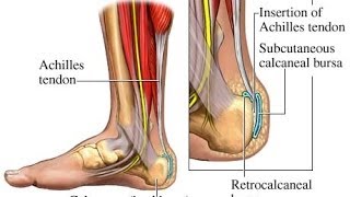 Plantar Fasciitis  Achilles Tendonitis Explained by a Top Pain Physician in Las Vegas Nevada [upl. by Ambrosi]