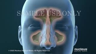 Sinusitis Surgery [upl. by Anerehs]