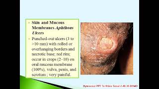 10 MIN REVISION neutriphilic dermatoses sweet syndrome pyoderma gangrosambehcet disease [upl. by Pedrick]