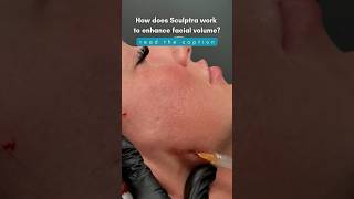 How Does Sculptra Work [upl. by Htims]