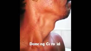 Le battement des carotides [upl. by Ranilopa334]