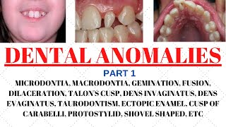 Developmental disturbances in teeth  Dental anomalies  Odontology notes  UGC NET Forensic science [upl. by Elyagiba]