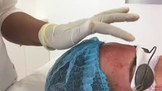 Reviderms MicroNeedling Treatment At Marafie Clinic [upl. by Ettenaj726]