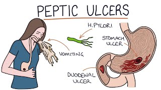 Understanding Stomach and Duodenal Ulcers [upl. by Adallard]