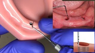 Measuring Tissue Height for LOCATOR and LOCATOR RTx Abutments [upl. by Jarred]