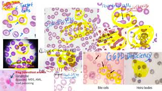 hematology in 10 min Peripheral blood smear examination under microscope [upl. by Nojid]