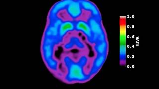 Video of AmyloidBeta Deposition in Autosomal Dominant Alzheimers Disease [upl. by Gerstner]