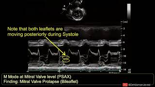 Bileaflet Prolapse of Mitral Valve on M Mode Echocardiography echocardiagram [upl. by Nwahsd798]