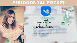 periodontal pocket carranza [upl. by Roma]