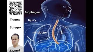 Esophageal Injury Trauma Questions and Answerstrauma esophagus esophageal surgerytips no1doctor [upl. by Eidnahs]