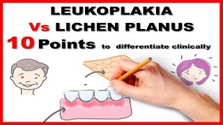 leukoplakia vs lichen planus  10 points to differentiate clinically [upl. by Yleak]