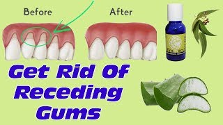 How To Grow Back Your Receding Gums With These Natural Remedies  Best Treatment For Gum Diseases [upl. by Dahraf653]