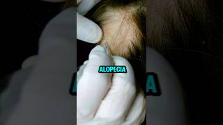 Di adiós a la alopecia 🌱AceiteDeBatana Alopecia BellezaNatural SaludCapilar [upl. by Belloir]