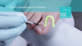 Entlastung für eingewachsene Nägel  RUCK® NAGELKORREKTUR  ORTOGRIP professional [upl. by Ainuj]