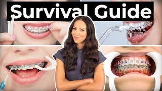 How To Prepare amp What To Expect With BRACES [upl. by Bernat]