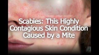 Scabies This Highly Contagious Skin Condition Caused by a Mite [upl. by Anuat794]