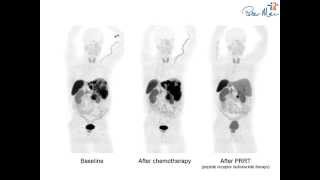 LuTate therapy for metastatic neuroendocrine tumour [upl. by Eintihw781]