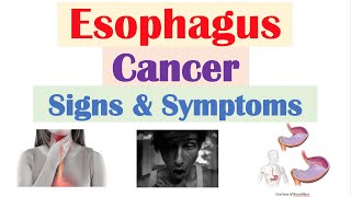 Esophageal Cancer Signs amp Symptoms amp Why They Occur [upl. by Norma]