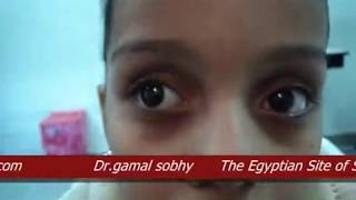 Intermittent Exotropia  الحول الوحشي المتقطع [upl. by Suzzy352]