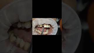 Upper lateral incisor compressive bioline implant tapping test after 6 months shorts [upl. by Veronique]