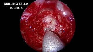 Endoscopic Transsphenoidal Hypophysectomy for Pituitary MacroadenomaDr Babu ARJSS AHER Mysore [upl. by Gilliam137]