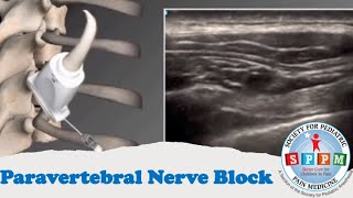 Paravertebral Nerve Block [upl. by Anawk]