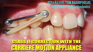 Class II correction with Carriere  Athanasios Tom Nasiopoulos [upl. by Negyam]