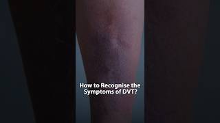 How To Recognise The Symptoms Of Deep Vein Thrombosis DVT  Dr Kunal Arora shorts [upl. by Esiuqram]