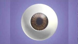 Astigmatic Keratoplasty AK [upl. by Mordy]