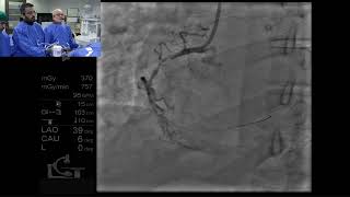 Endoluminal reconstruction of a diffusely diseased and tortuous RCA by Tejas Patel [upl. by Brinkema]