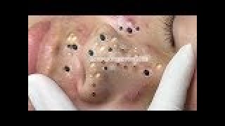 Black head removed from nose  Loan Nguyen latest video 0629 cystic blackheads whiteheads removal [upl. by Nwahsyd]