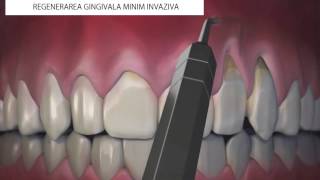 Regenerare gingivala minim invaziva [upl. by Germin]