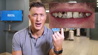 Dentist says DO NOT CROWN YOUR TEETH  Proves it with a Clinical example [upl. by Releehw]