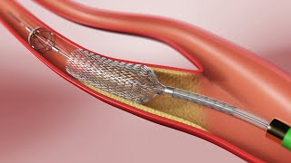 Carotid Angioplasty and Stenting 3D Animation [upl. by Shelli]