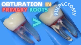 🟡Obturation in Primary Teeth Roots 🟢 Pulpectomy 🔵 [upl. by Anrev]