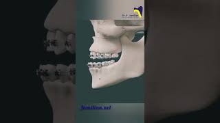 Le Fort I osteotomy for maxillary advancement dentistOsteotomy orthodontistMaxillaryAdvancement [upl. by Reemas]