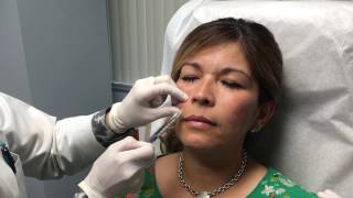 Juvederm Vollure Injection Treatment [upl. by Ianteen]