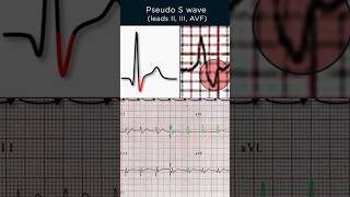 AVNRT ECG Pseudo S wave [upl. by Navi808]