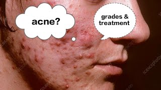 Acne Vulgaris  common problem [upl. by Montano]