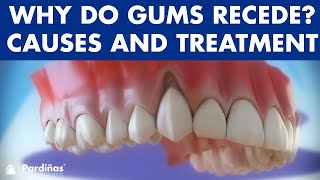 Gum recession  Treatment of gingival retraction © [upl. by Ahseniuq]