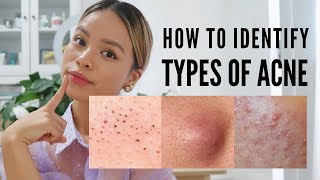 How to treat EVERY type of acne With Pictures [upl. by Sokairyk217]