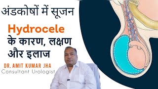 Hydrocele  के कारण अंडकोष में सूजन का क्या इलाज है   अंडकोष की सूजन [upl. by Jehovah951]