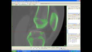 Processing a DICOM file to 3D using Mimics [upl. by Arim]