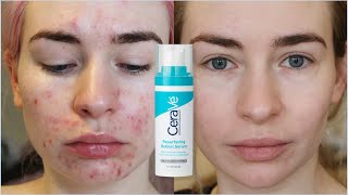 Cerave resurfacing retinol serum review [upl. by Westmoreland]