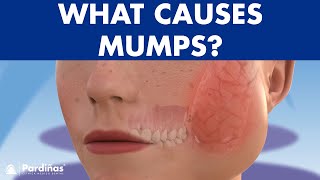 Mumps parotitis and other salivary glands conditions sialadenitis sialolithiasis mucocele © [upl. by Feola]