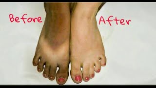 TACHES SOMBRES AUX PIEDS ASTUCES POUR SEN DEBARASSER RAPIDEMENT [upl. by Ettessil260]